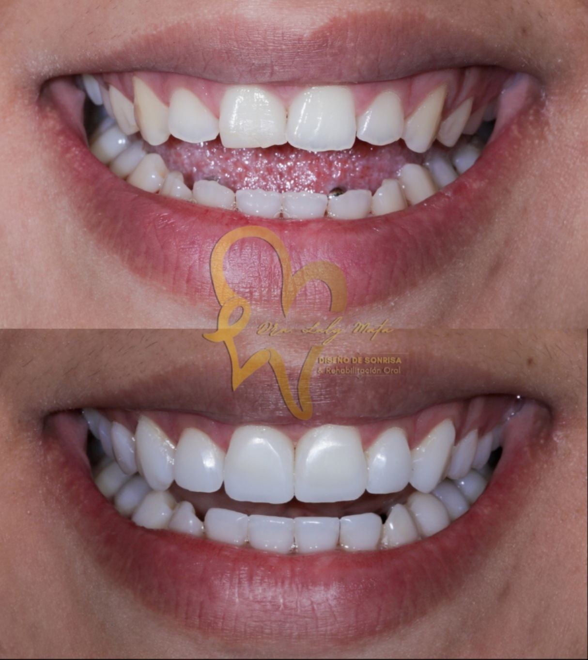 Resultado de diseño de sonrisa